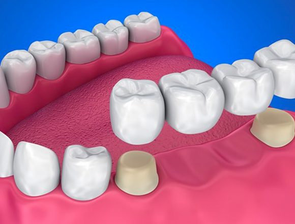 Dental Bridges