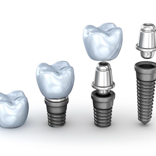 What are Implant – Supported Dentures?