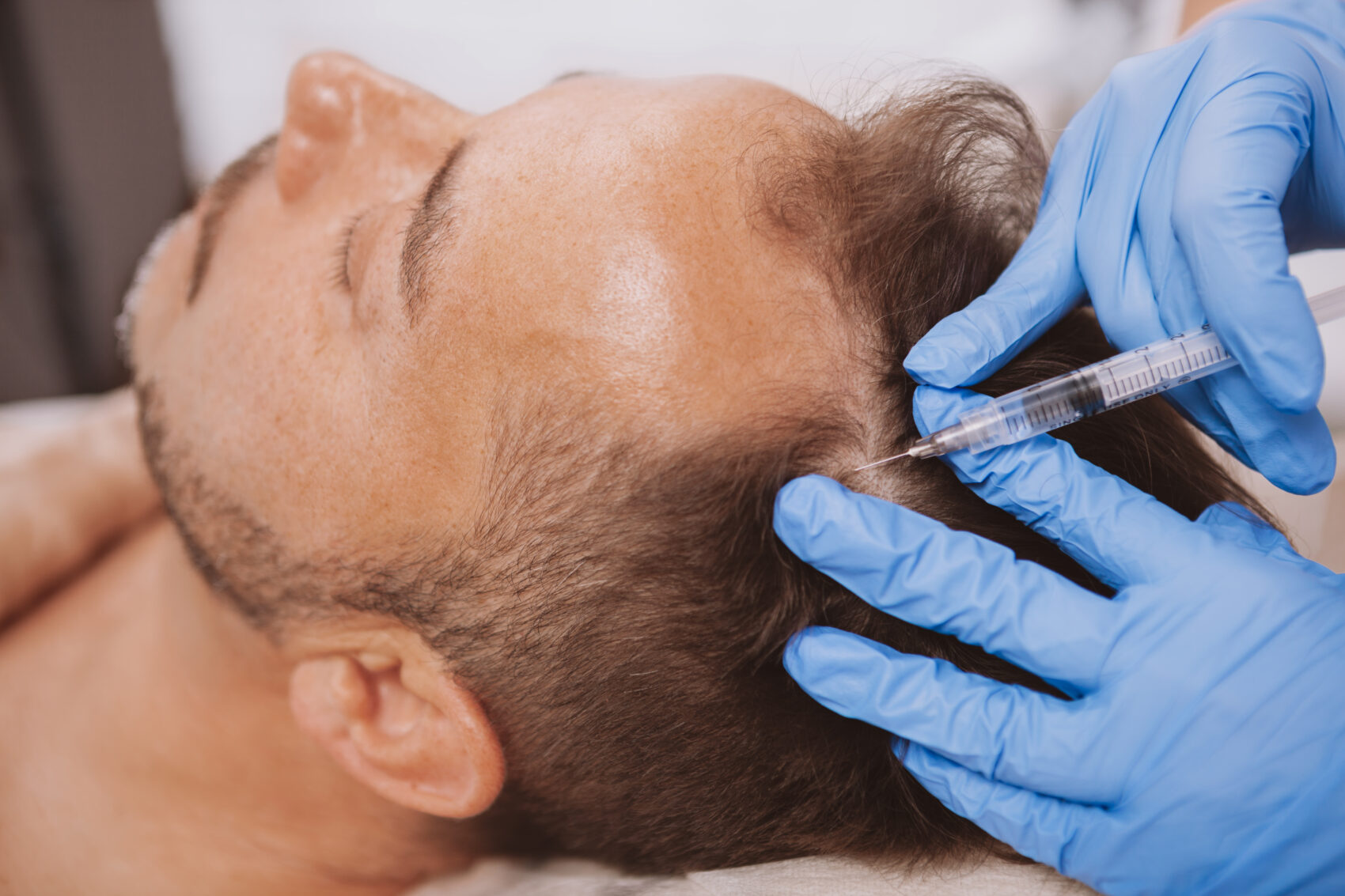 hair transplant antalya