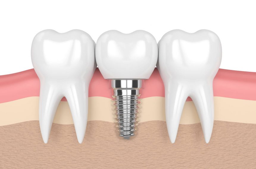 Who is the dental implant for?