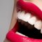 What Are the Advantages of Porcelain Veneers?